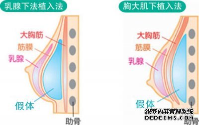 假体隆胸多少钱？副作用？