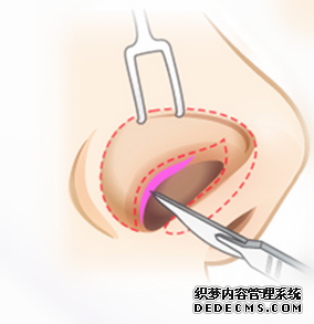 【惜美整形网】了解鼻部整形的手术方法