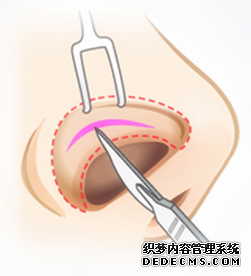 【惜美整形网】了解鼻部整形的手术方法